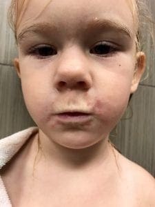 Hand Foot Mouth rash